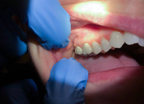 Best Emergency Tooth Extraction in Shasta Lake, CA