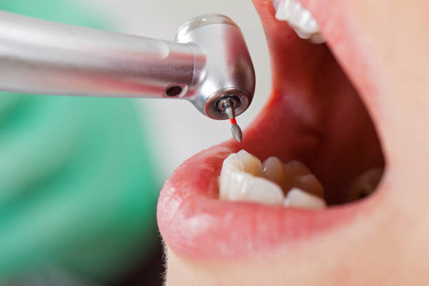 Best Emergency Root Canal Treatment in Shasta Lake, CA